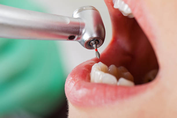 Best Emergency Tooth Extraction in Point, TX
